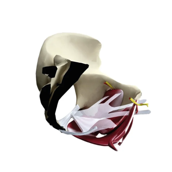 Malla de Corrección de Prolapso Moderado a Severo Surelift