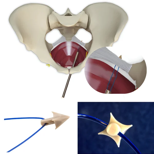 Anchosure Arpón Fijación al Ligamento Sacroespinozo